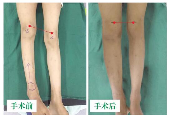 女孩墜梯右腿縮短5cm，幸得醫(yī)生及時診治恢復(fù)正常腿型